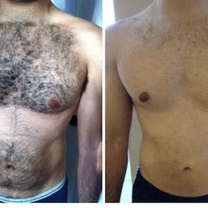 Before-and-After-Laser-Hair-Removal-men