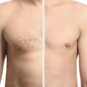 Before_After_01_PRP