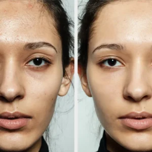 Before_After_01_Peel_F_P