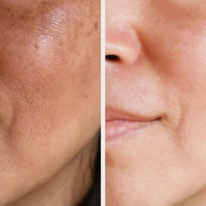 Before_After_02_Peel_F_P