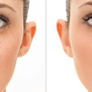 Before_After_03_Peel_F_P