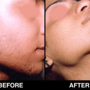 Hair-Removal-Before-After-3