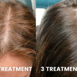 Exosomes will trigger healing, cell stimulation and natural regeneration of hair follicles. Exosomes potent stimulants, otherwise known as cytokines, stimulate the growth of hair follicles.  Exosome therapy is ideal for people with thinning hair, excessive shedding or hair loss. Exosomes are regenerative cells that can heal, repair, stimulate and restore cells and tissues.VitalityMD Exosome therapy Toronto.