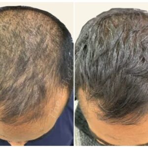 exosomes-hair-treatment 2