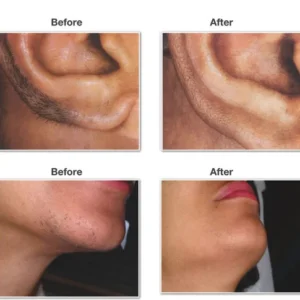 laser-hair-removal-500x500
